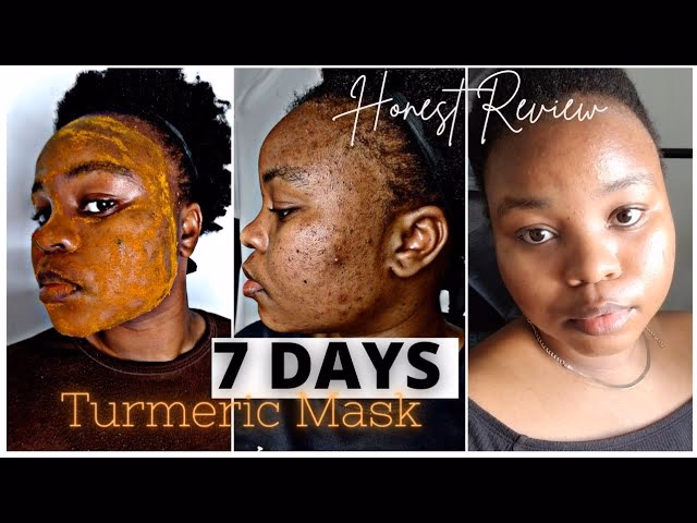 Can curry leaves help with pimples?